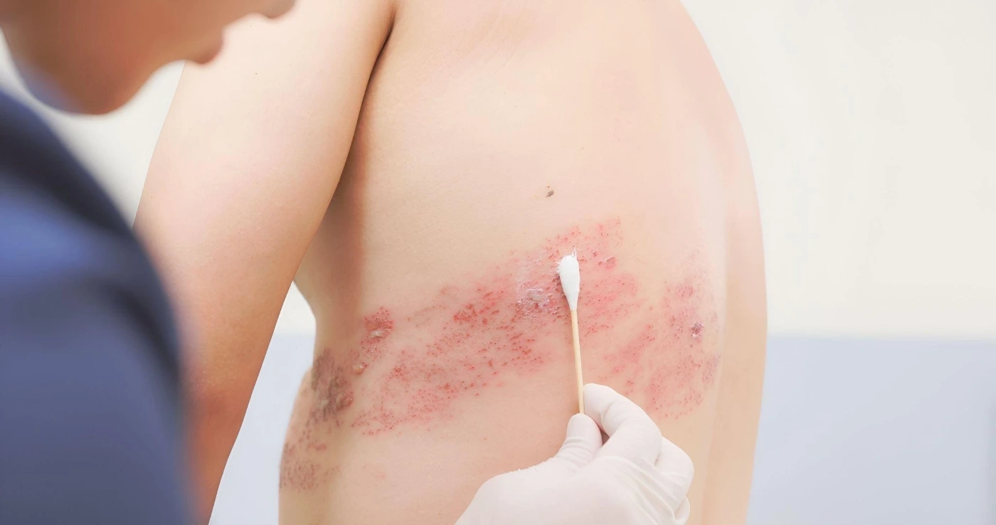 shingles treatment