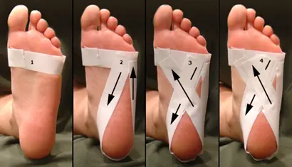 low-Dye taping technique for plantar fasciitis treatment