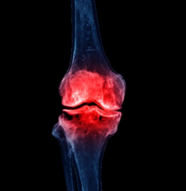 MRI image of inflamed knee joint