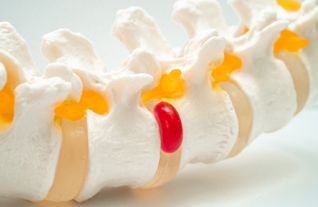 Spine showing a herniated disc highlighted in red